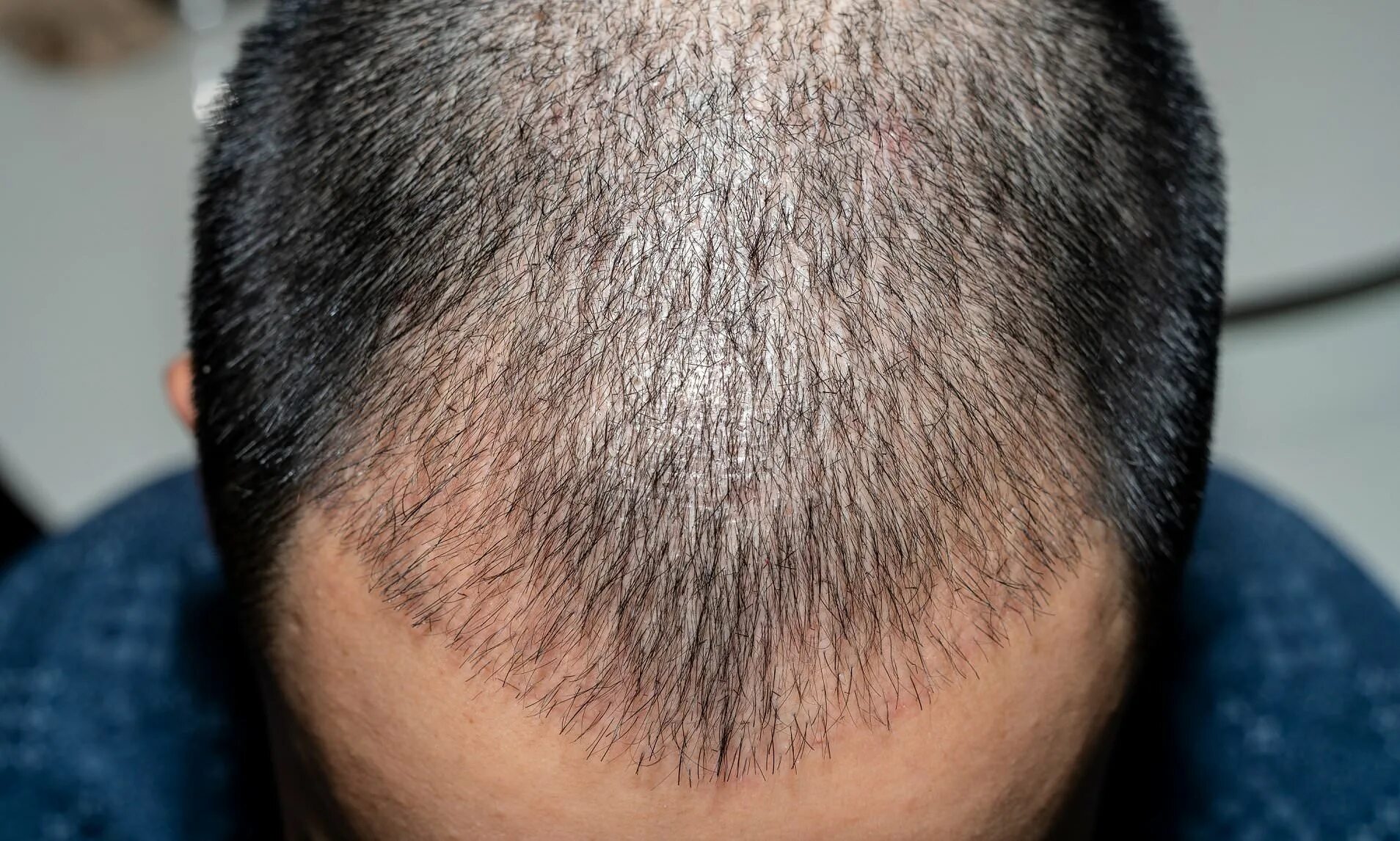 Волосы у мужчин на голове. Выпадают волосы после пересадки