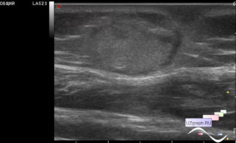 узи мягких тканей заключение. фиброма мягких тканей на узи. фиброма мягких тканей на узи. узи картина липомы мягких тканей. узи молочных желез.