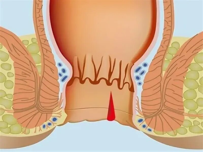 Как лечится трещина. Трещина анального отверстия. Геморрой трещины заднего прохода. Микротрещина заднего прохода. Иссечение трещины заднего прохода.