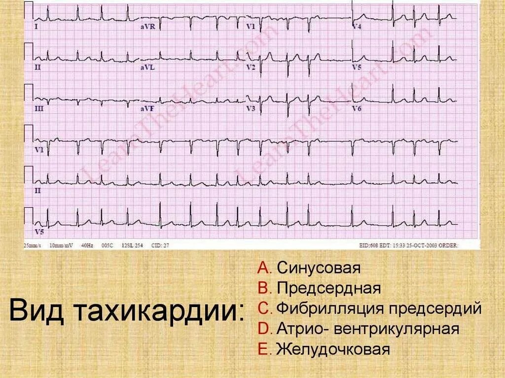 Трепетание предсердий наджелудочковая на ЭКГ. Тахикардия предсердий на ЭКГ. ЭКГ при пароксизмальной тахикардии и фибрилляции предсердий. Трепетание предсердий ЭКГ И синусовый.