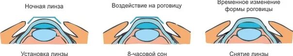 Сколько стоит ночные линзы для восстановления зрения. Ортокератология ночные линзы. Линзы ночные для коррекции зрения. Жесткие ночные линзы для коррекции зрения. Линзы на ночь для восстановления зрения.