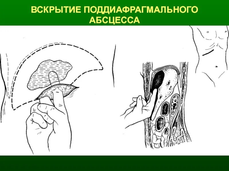 Как лечить абсцесс. Вскрытие поддиафрагмального абсцесса. дренирование поддиафрагмального абсцесса. вскрытие и дренирование поддиафрагмального абсцесса. пункция поддиафрагмального абсцесса.