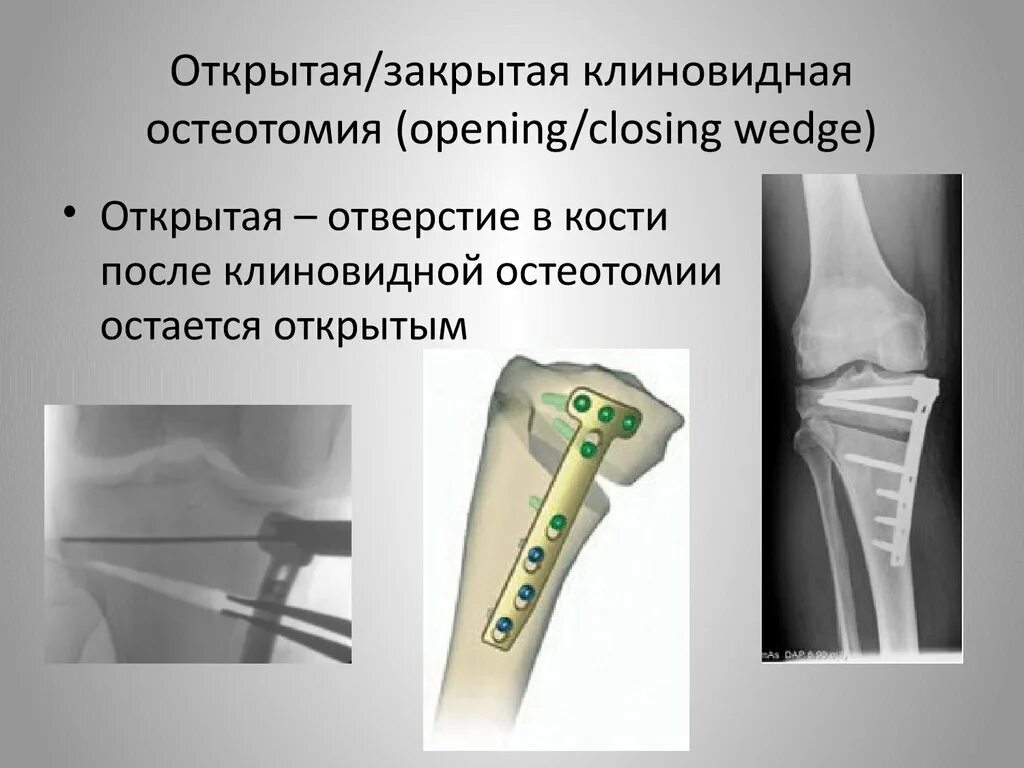 Корригирующая остеотомия тбс. Остеотомия бедренной кости. Остеотомия большеберцовой кости. Корригирующая остеотомия бедренной кости. Остеотомия большеберцовой кости реабилитация.