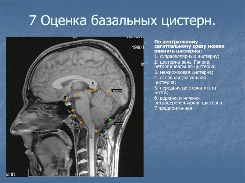 Базальные цистерны головного мозга кт анатомия. Цистерны мозжечка анатомия. Верхняя мозжечковая цистерна мозга мрт. Базальные цистерны головного мозга кт. Расширенные ликворные пространства