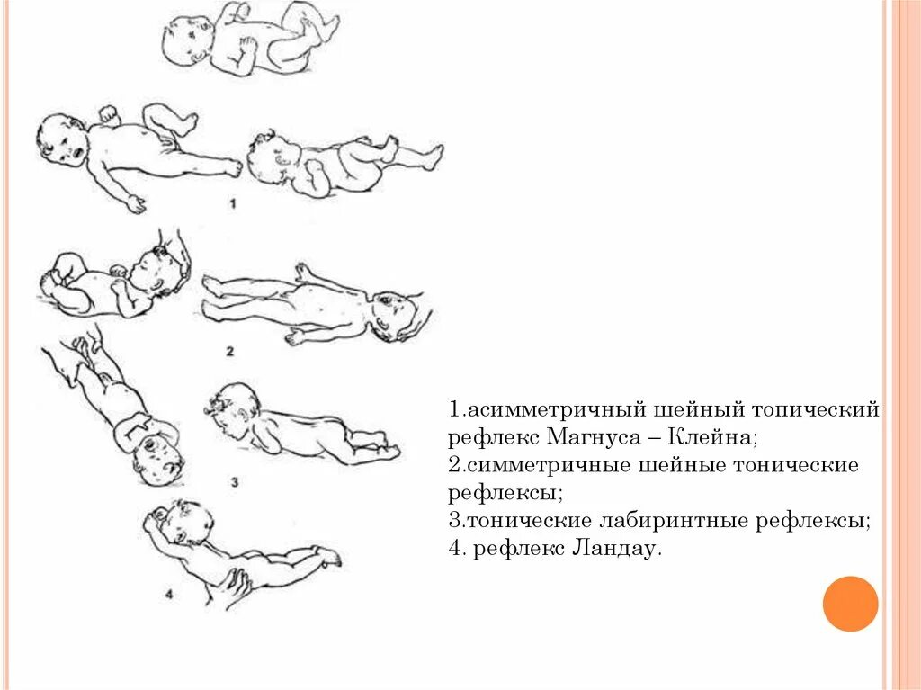 Позотонические рефлексы новорожденных. Лабиринтный тонический рефлекс. Лабиринтный рефлекс новорожденного. Тонические рефлексы новорожденного.