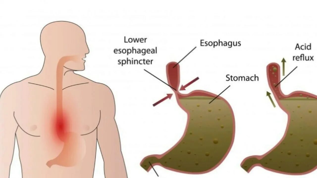 Заброс кислоты в пищевод симптомы