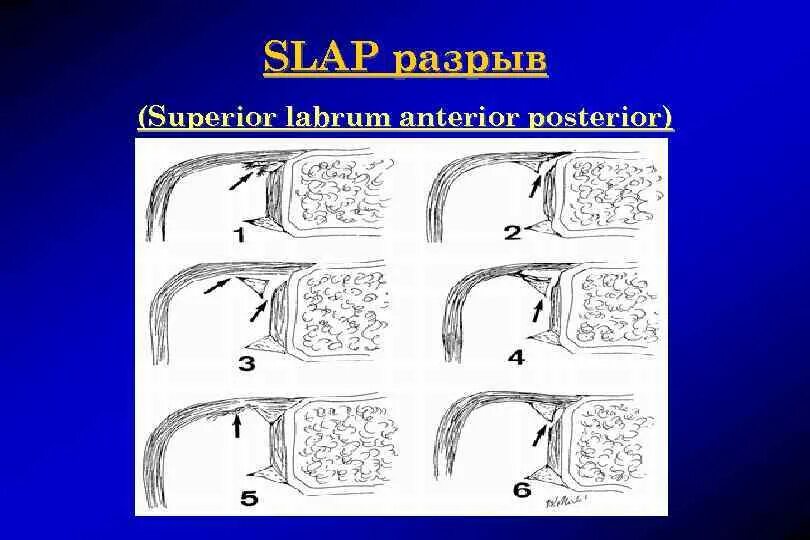 Slap повреждение плечевого сустава степени. Slap повреждение плечевого сустава на мрт. Slap 1-2 повреждения суставной. Слап синдром плечевого.