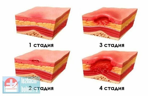 Картинки ЛЕЧЕНИЕ СТЕПЕНИ ПРОЛЕЖНЕЙ