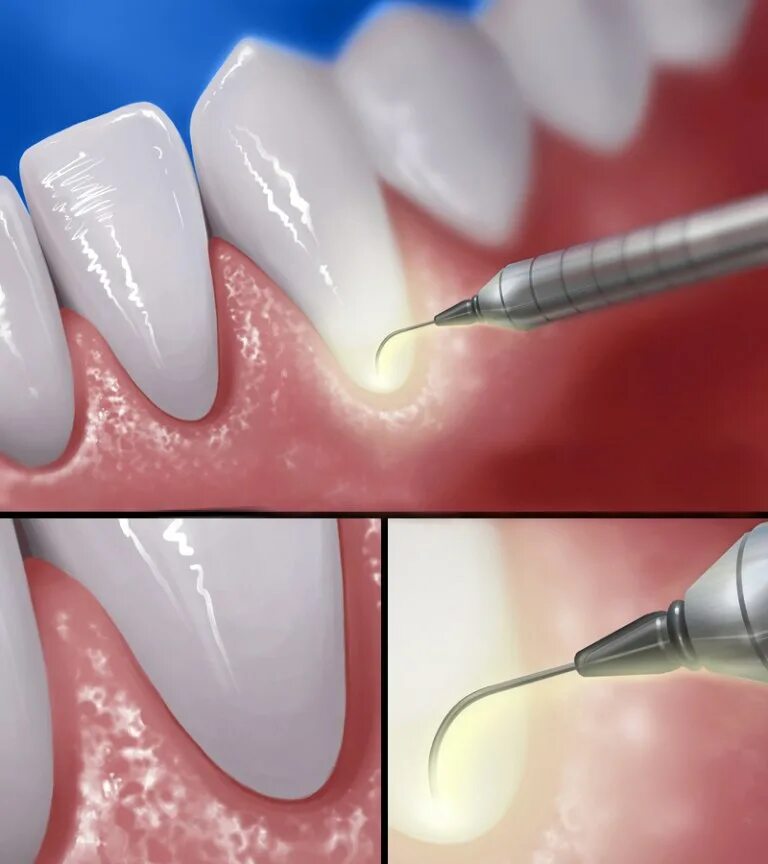 Скейлинг пародонтальных карманов. Алекон Дент. Комплексная пародонтологическая чистка к. Periodontal Pocket 3 d. Лазерное десен