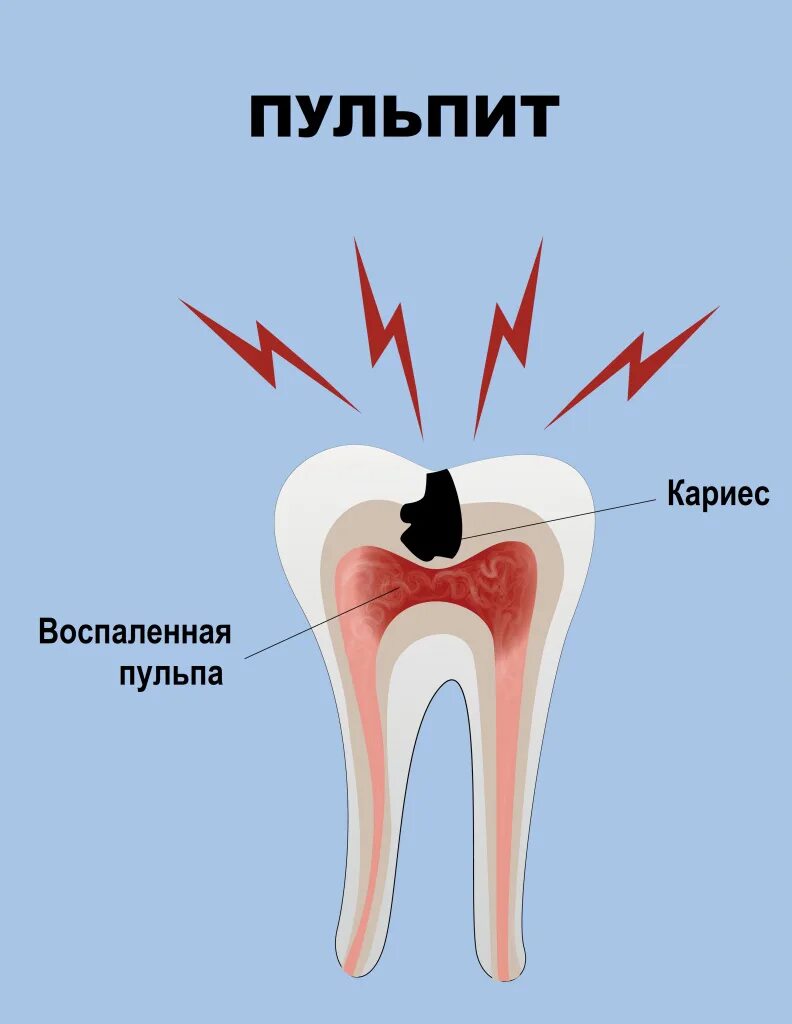 Как вылечить пульпит