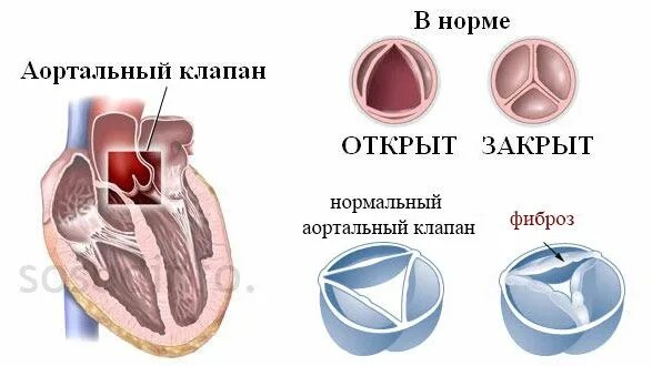 Фиброз кольца аортального клапана что это. Митральный клапан и аортальный клапан. Фиброз створок митрального клапана. Фиброз створок аортального клапана.