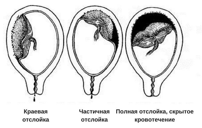 Отслойка хориона на ранних сроках. Полная и частичная отслойка плаценты. Краевая и Центральная отслойка плаценты. Преждевременная отслойка плаценты. Формы преждевременной отслойки плаценты.