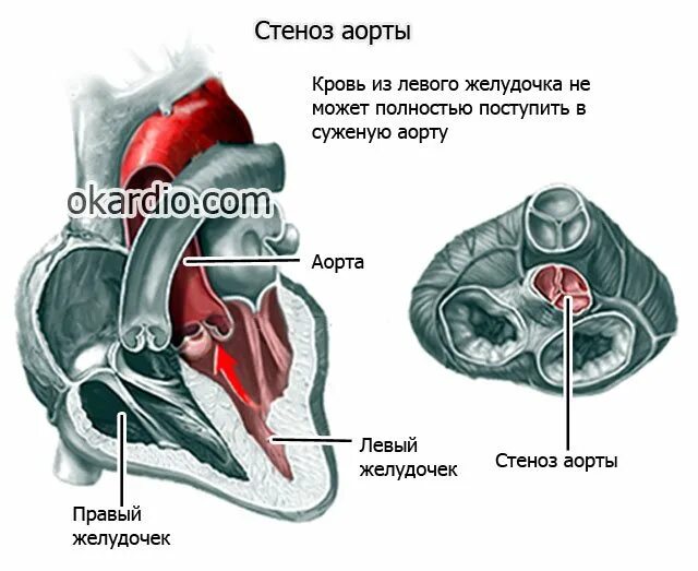 Чем лечить уплотнение аорты сердца. Стеноз клапана левого желудочка. левого желудок аорта желудочка. уплотнение клапанного аппарата сердца и аорты. дилятация левого желудочка сердца.