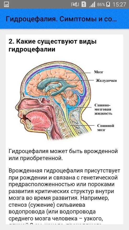 Гидроцефалия симптомы у взрослых. Наружная водянка головного мозга. Гидроцефалия головного мозга симптомы.