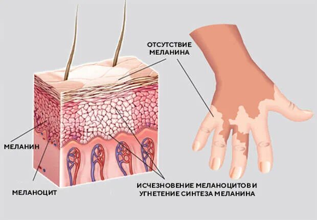 Пигмент кожи меланин находится. Строение эпидермиса меланоциты. Строение меланоцита. Клетки меланоциты в коже.