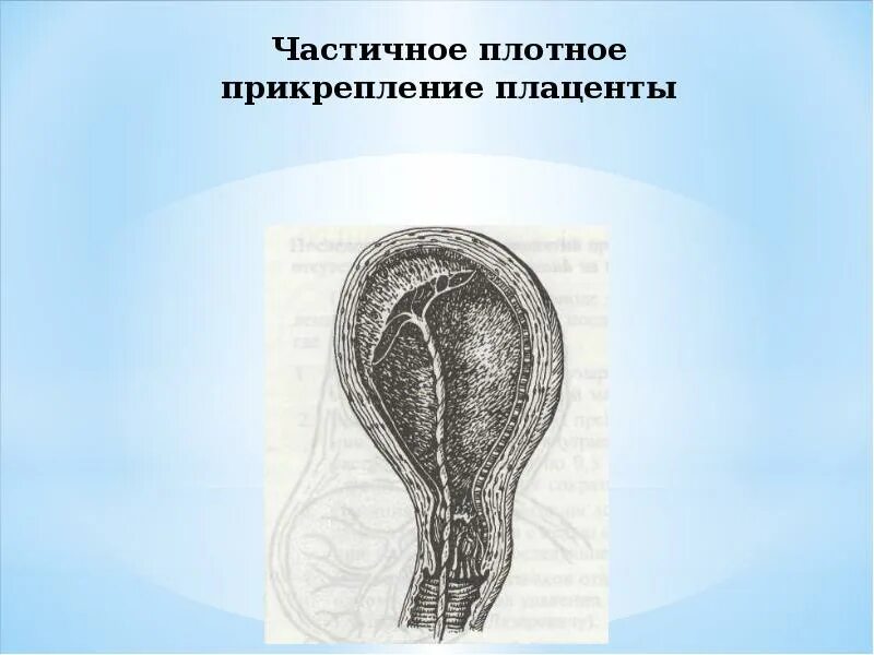 Барнаул роды с врастанием плаценты. Барнаул роды с врастанием плаценты. Плотное прикрепление и истинное приращение плаценты. Плотное прикрепление плаценты. Тактика ведения беременной при предлежании плаценты.