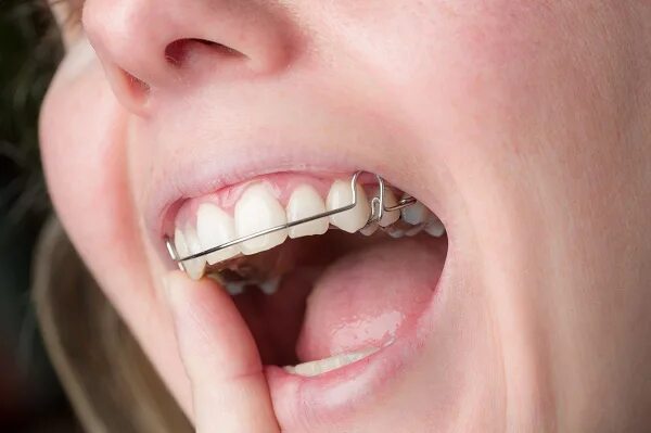 Скобы для выпрямления зубов. Скобы для выравнивания зубов для детей. Скобы для выравнивания зубов. Скобы для детей. Прозрачные брекеты.