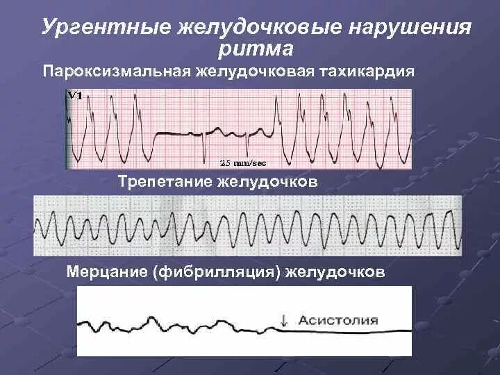 Пароксизмальная тахикардия мерцательная аритмия. Желудочковая тахикардия и фибрилляция желудочков. трепетание желудочков и пароксизмальная тахикардия. желудочковая тахикардия ритм на экг. пароксизмальная экстрасистолия экг.