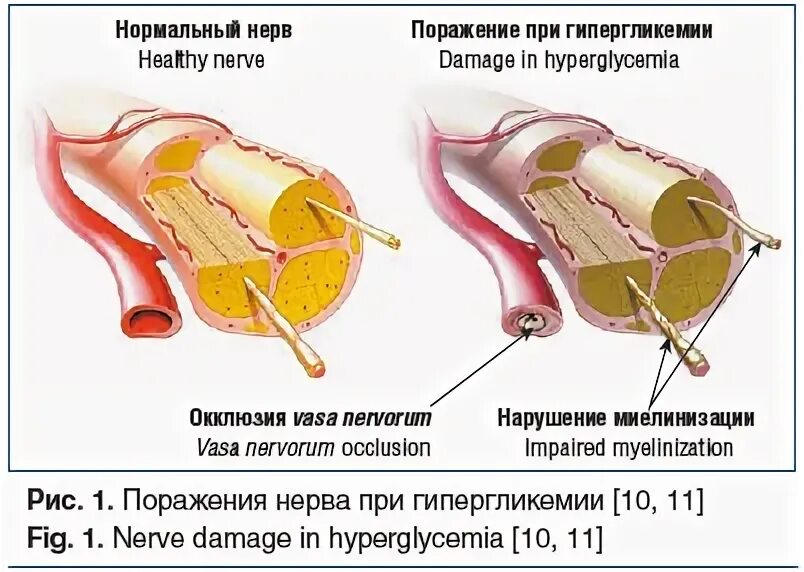 Не отличать пораженья от победы. Диабет поражает нервы. Рукава пакеты охлаждающие полинейропатия. Нагиев поражение нерва.