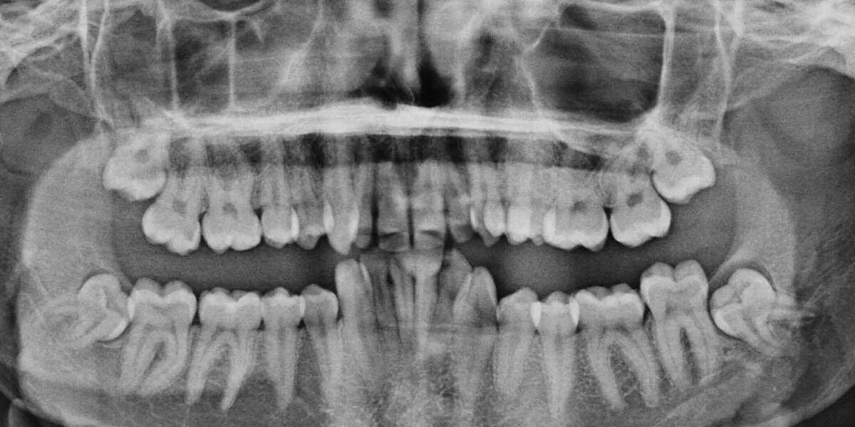 Сложное удаление зуба. Ретинированный зуб мудрости снимок. Ратированные зубы мудрости. Ретинированный зуб мудрости рентген.