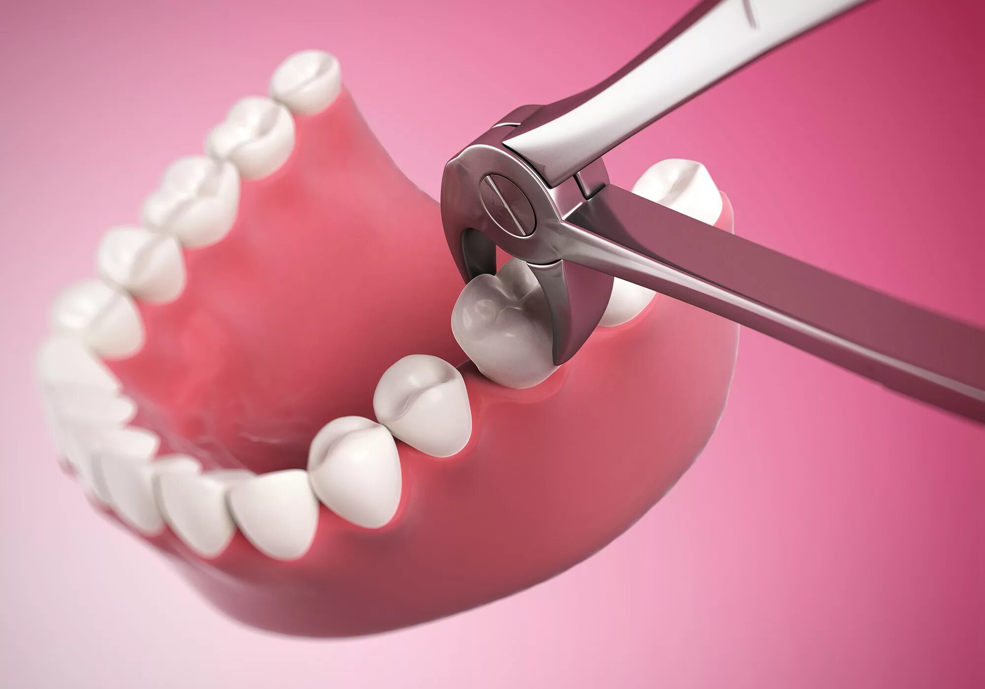 Сложное удаление зуба. Хирургическая стоматология. Зубы стоматология. Хирургия стоматология.