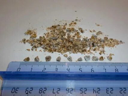 Как выходит песок из мочевого пузыря