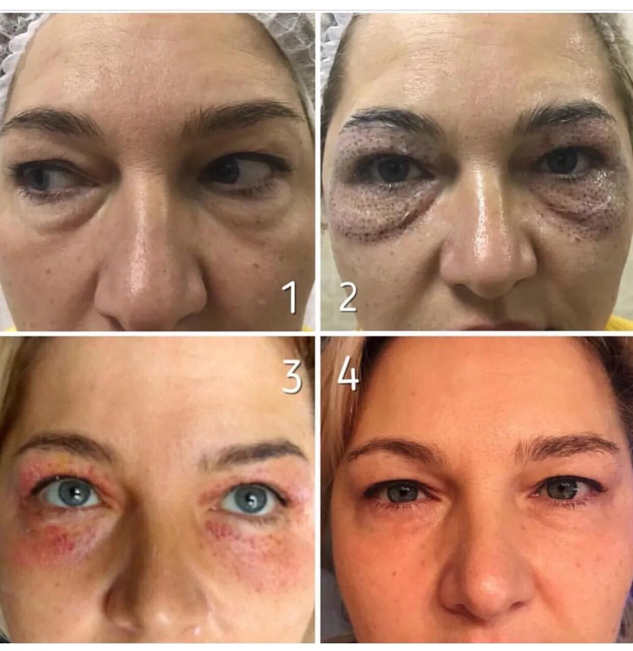 Фракционный фототермолиз со2. Лазерная шлифовка морщин около глаз. Омоложение лица до и после. Фракционное лазерное омоложение до и после. Косметология.