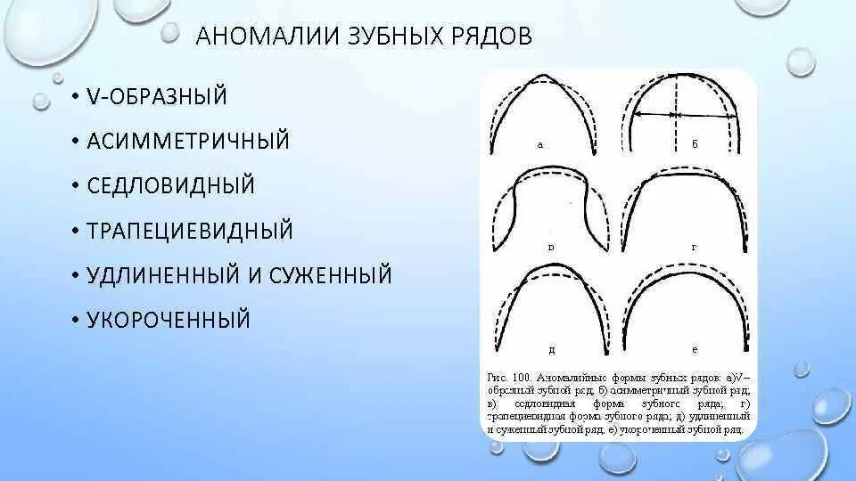 Седловидная форма верхней челюсти. Аномалии форм зубных рядов причины. Аномалии размера и формы зубных рядов по Калвелису.