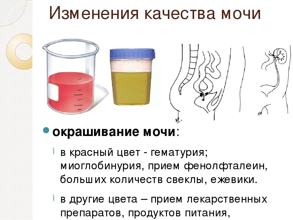 Болезни мочу мужчин. Моча с примесью крови. Красноватая моча.