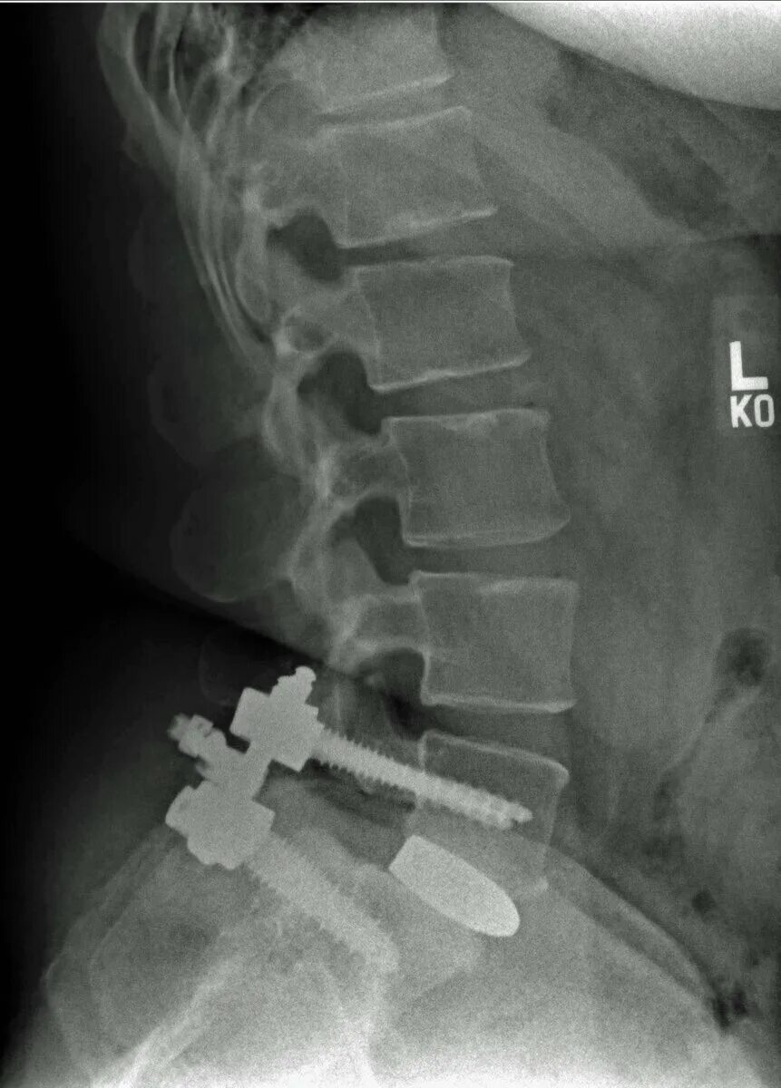 Спондилолистез l5 рентген. Спондилолистез l2 l3 позвонка. Антелистез l5 рентген. Спондилолистез l4 кпереди. Операция смещение позвоночника