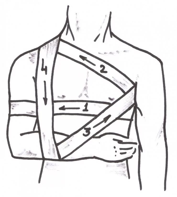 Повязка Дезо при переломе ключицы. Дезо повязка бинтом алгоритм. Повязка Дезо гипсовая техника. Повязка Дезо при переломе ключицы наложить.