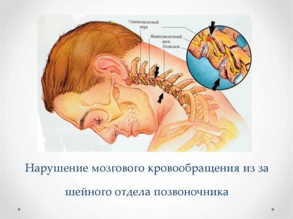 Шейный остеохондроз берут ли в армию. Берут ли в армию с остеохондрозом шейного отдела. С остеохондрозом берут в армию. Остеохондроз шейного отдела армия.