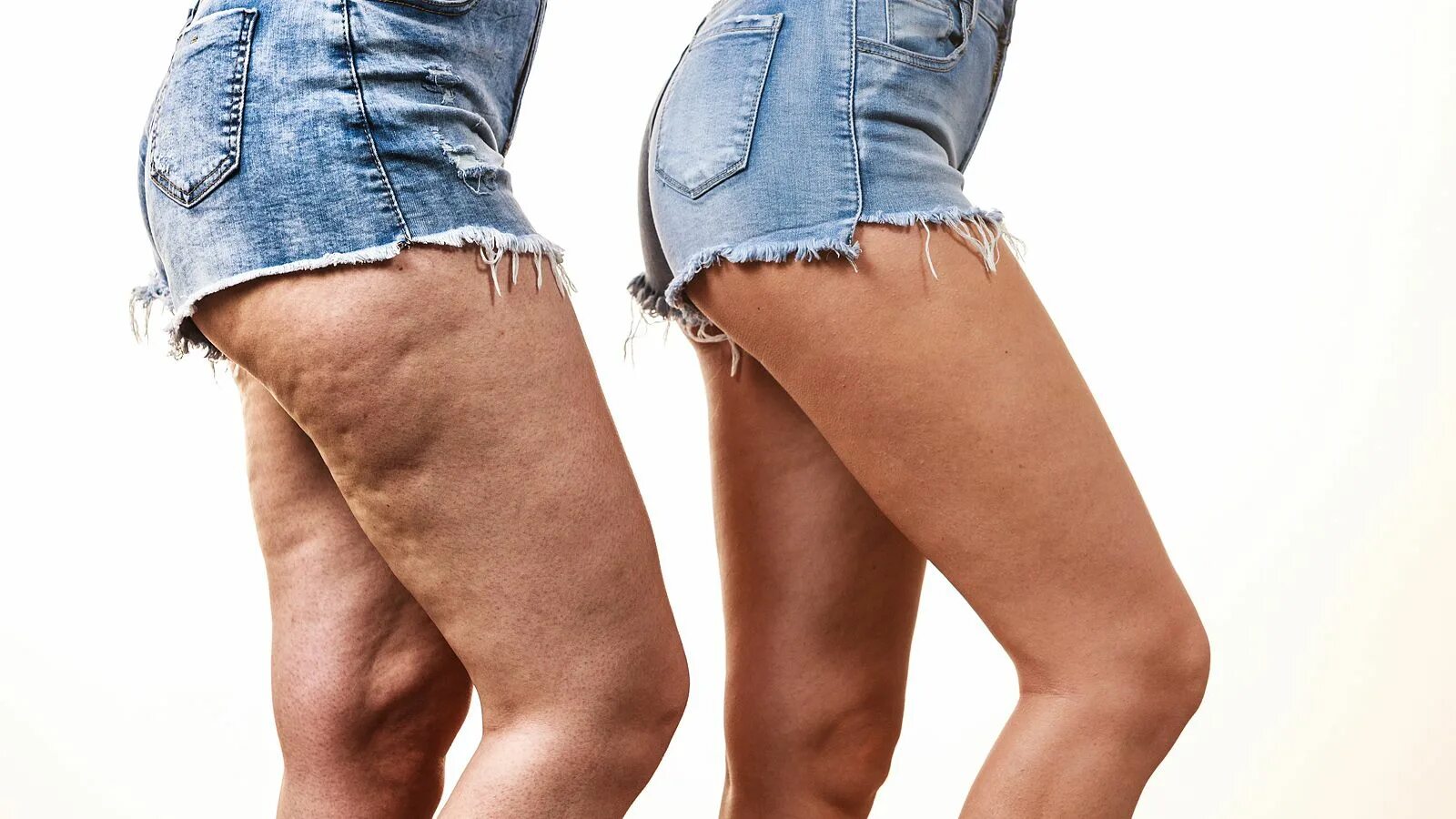 Целлюлит у худых. Целлюлит у девушек. Женское тело. Скарлетт йоханссон целлюлит. Целлюлит у худых девушек.