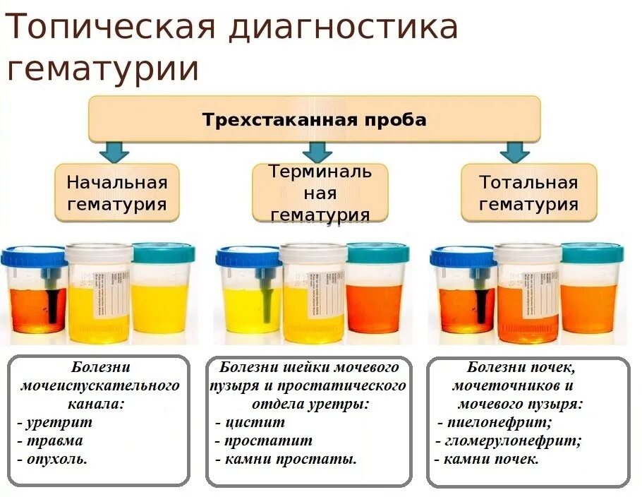 Трехстаканная проба мочи. Гематурия трехстаканная проба. Трехстаканная проба Томпсона. Трехстаканная проба мочи Томпсона. Трехстаканная проба алгоритм.