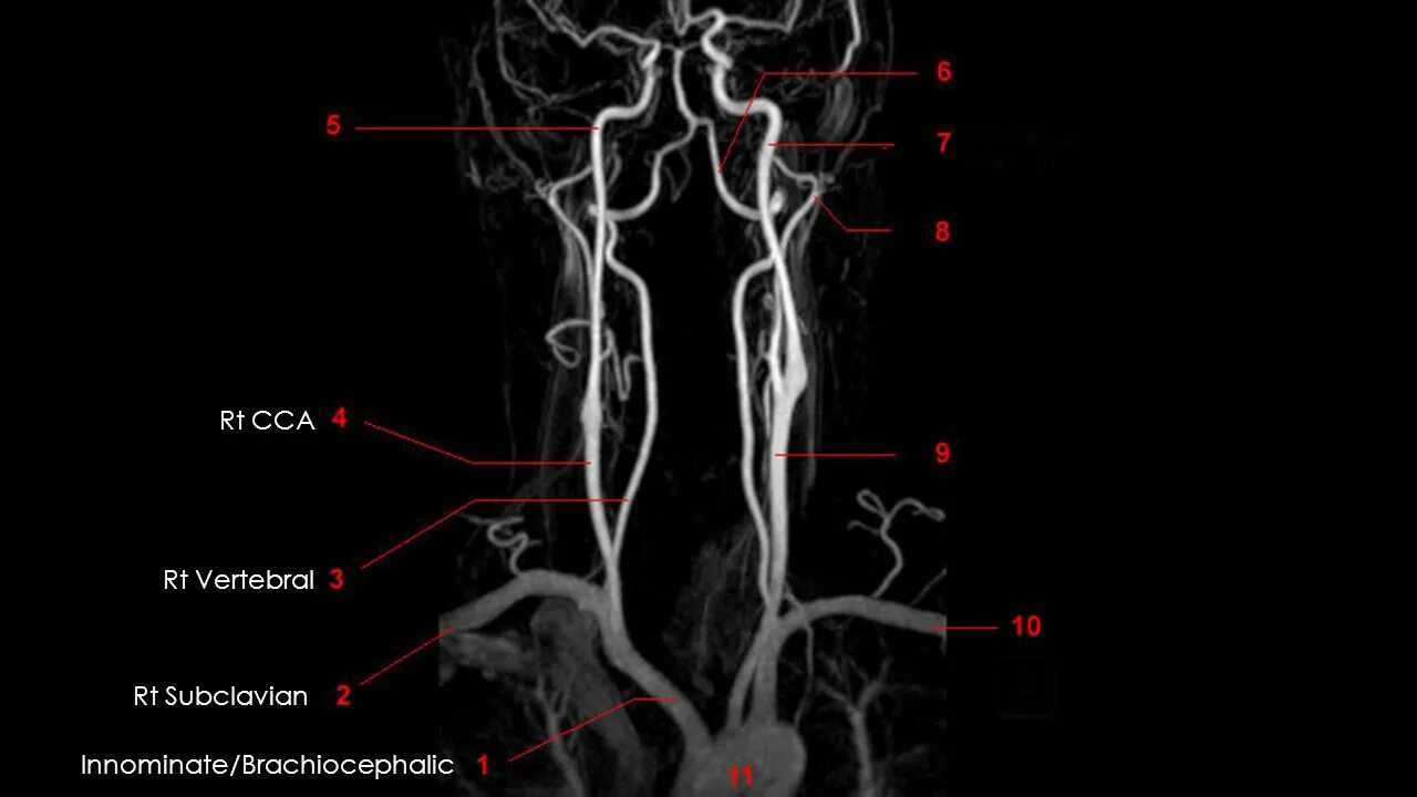 брахиоцефальные артерии вса. брахиоцефальные артерии вса. анастомозы артерий головы. брахиоцефальные артерии вса. анастомозы внутренней сонной артерии.