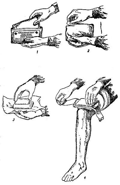 Перевязка чистой раны алгоритм. ИПП перевязочный пакет алгоритм. Наложение ИПП. Асептическая повязка ИПП. Перевязка гнойных РАН алгоритм.