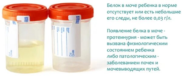 Обнаружения белков в моче. 5 г/л. Анализ мочи общий расшифровка эпителий плоский. ,tkr d vjxt. Протеинурия.