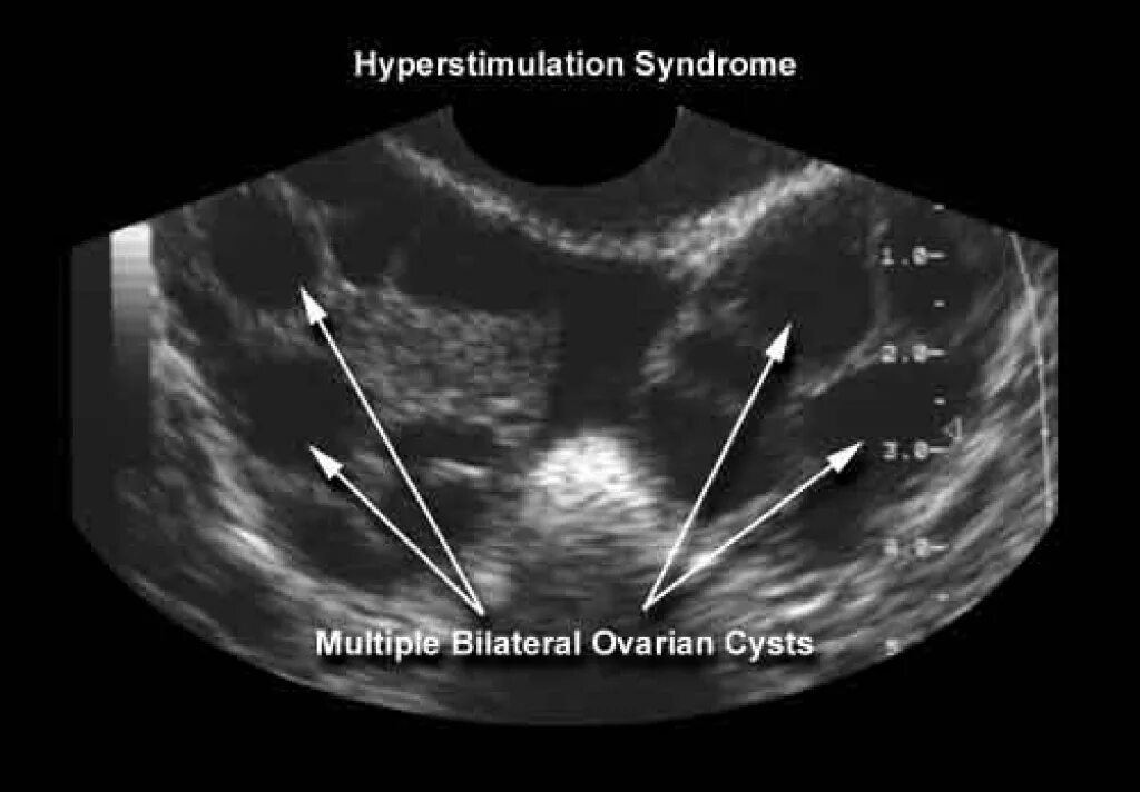 Гиперстимуляция яичников после. Синдром гиперстимуляции яичников УЗИ. Синдром гиперстимуляции яичников симптомы. Синдром гиперстимуляции яичников патогенез.
