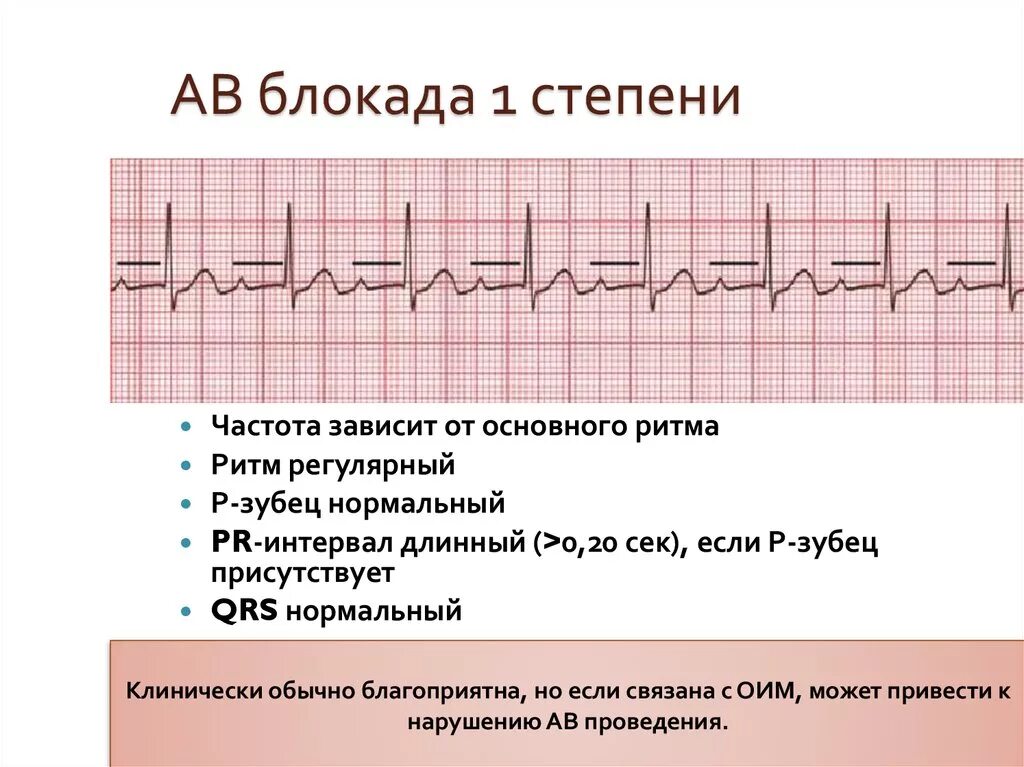 Блокада сердца опасно для жизни. ЭКГ при атриовентрикулярной блокаде 1 степени. АВ блокада 1 степени на ЭКГ У детей. АВ блокада 1-й степени ЭКГ. АВ блокада 1 степени на ЭКГ.