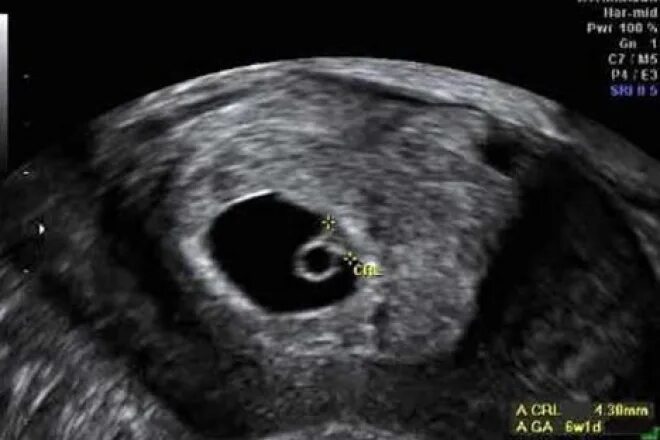 Плодное яйцо 3мм и желточный мешок 3мм. Плодное яйцо 9,5 мм желточный мешок 2,3 мм. Эмбрион и желточный мешок на 5 неделе УЗИ. УЗИ 6 недель беременности желточный мешок.