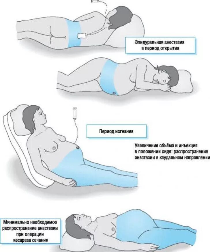 Почему когда лежишь на спине живот. Эпидуральная анестезия при беременности. Эпидуральная анестезия при беременности показания. Эпидуральная анестезия при родах кесарево сечение. Анестезия при родах эпидуральная анестезия.