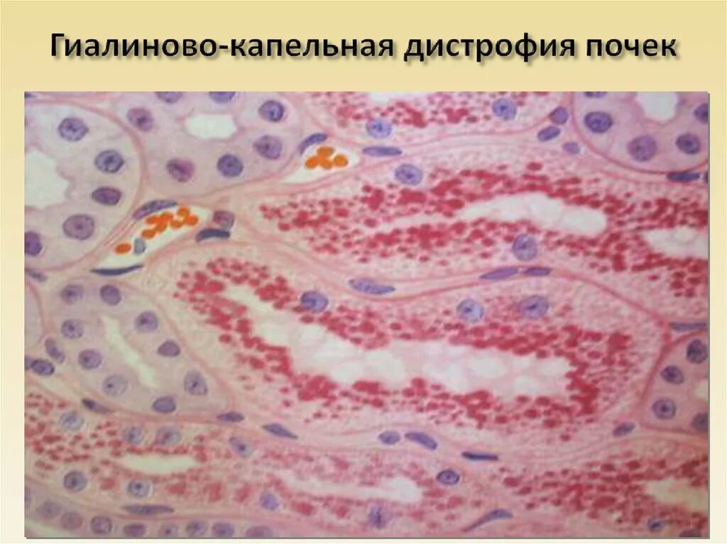 Гидропическая дистрофия почки. Микроскопическая картина атрофии. Зернистая дистрофия патанатомия. Паренхиматозные дистрофии белковые зернистая. Гидропическая дистрофия почки.