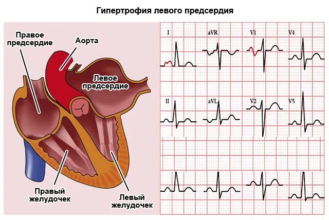 Гипертрофия что это. Признаки гипертрофии левого предсердия на ЭКГ. Гипертрофия правого предсердия на ЭКГ. Дилатация правого предсердия ЭКГ. Гипертрофия левого предсердия и правого желудочка.