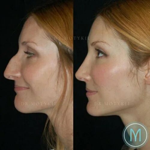 Ринопластика лица до и после One of our beautiful patients before and after #rhinoplasty and #fatgrafting #su