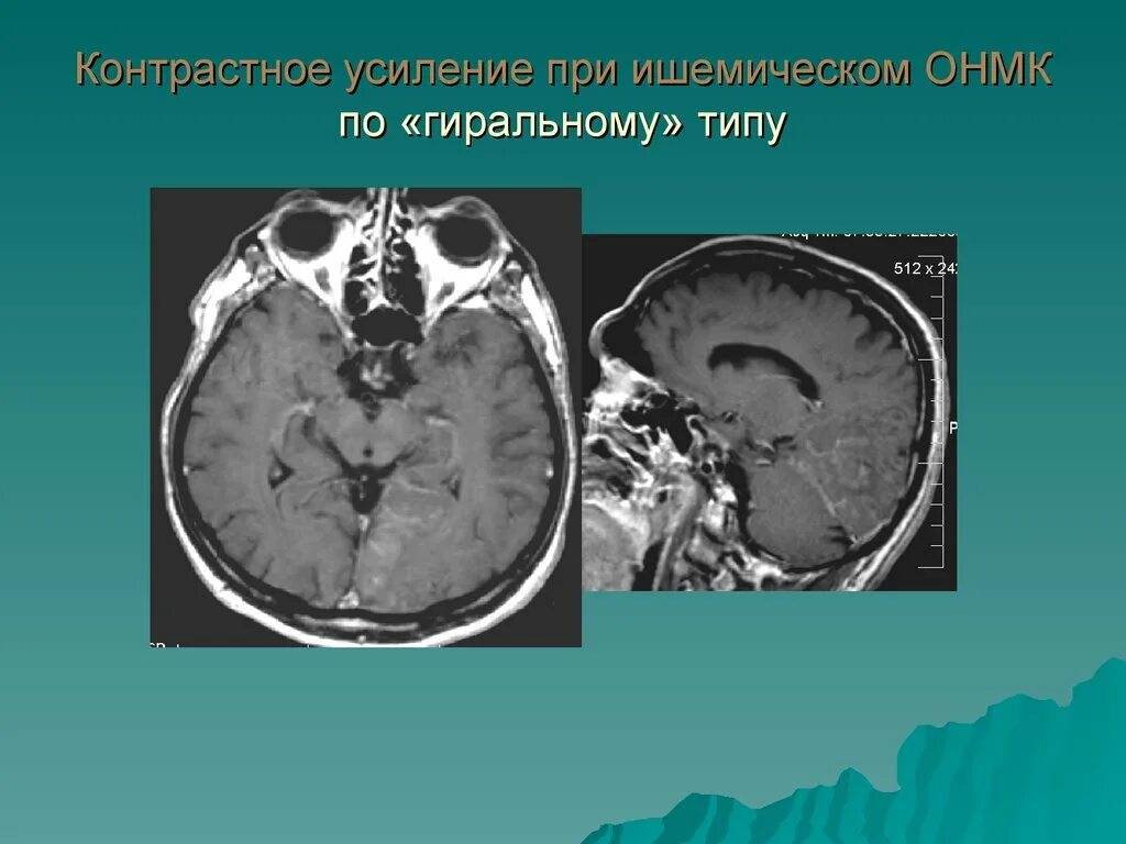 Подострый ишемический инсульт на кт. Подострый онмк. Подострый ишемический инсульт на кт. Фазы ишемического инсульта на кт. Подострый онмк.