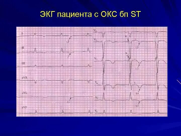 Экг подъем. ЭКГ синдромы Окс. Коронарный синдром на ЭКГ. ЭКГ при остром коронарном синдроме. Окс с подъёмом St ЭКГ.