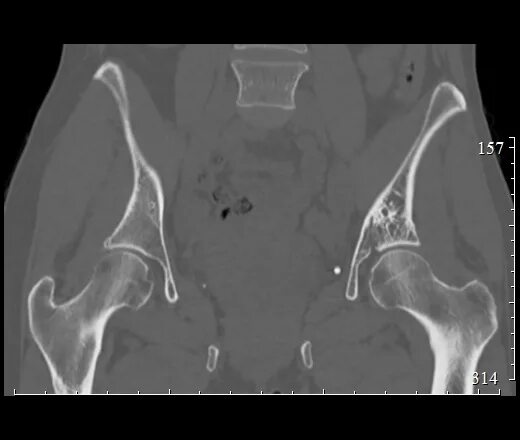 Кт подвздошной кости. Остеомиелит подвздошной кости кт. Остеома подвздошной кости на кт. Остеохондрома лонной кости кт.