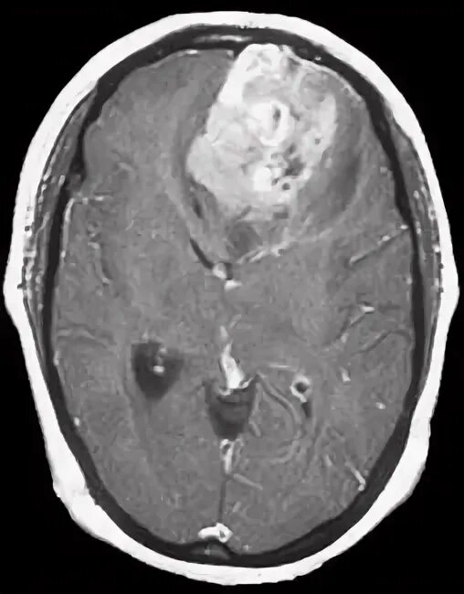Глиобластома головного мозга. Опухоль головного мозга астроцитома. Глиобластома 4 степени.