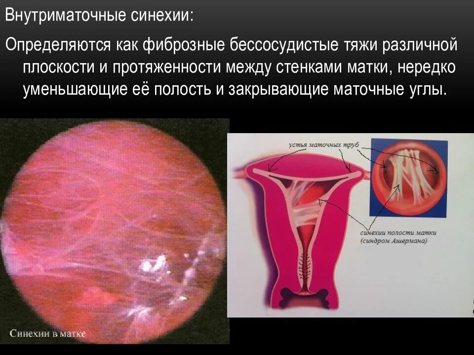 Плотная шейка. Внутриматочные спайки синехии. Внутриматочные синехии (синдром Ашермана). Синдром Ашермана гистероскопия.