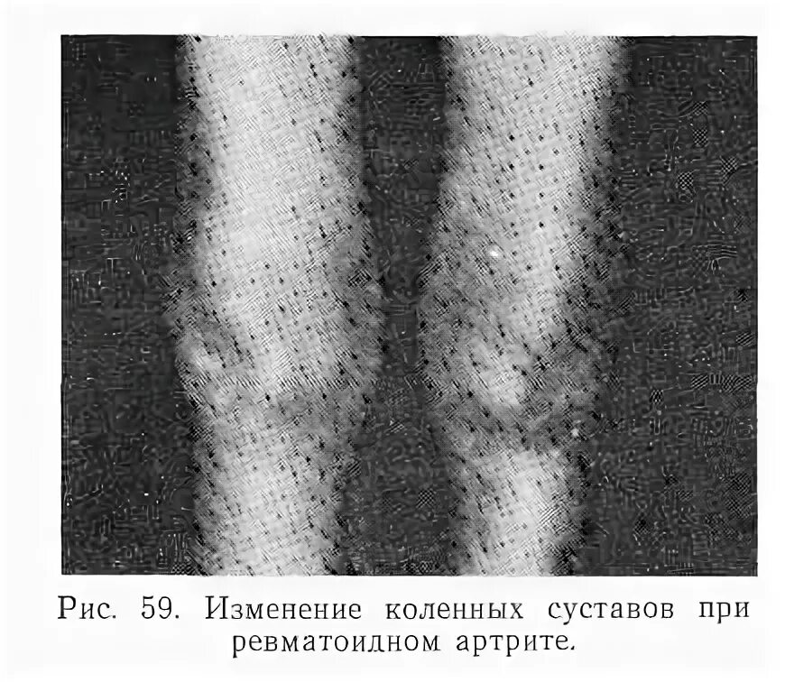 Изменение формы сустава